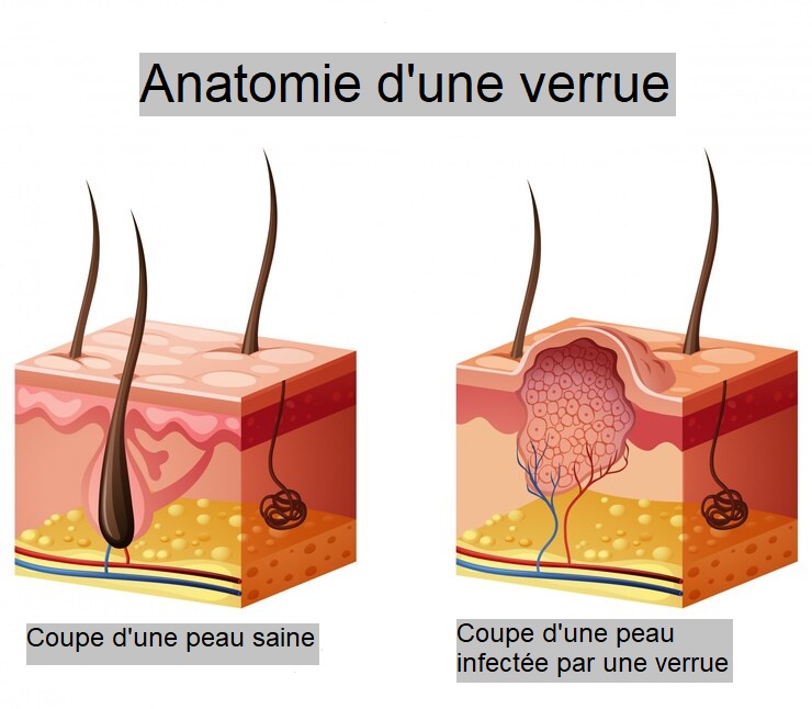 Anatomie et coupe de peau pour montrer une verrue.